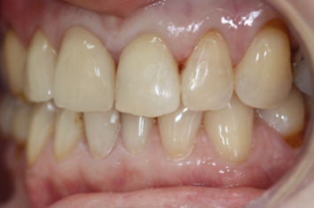 After - Dr Emma Facial Aesthetics