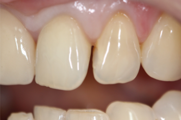 Before - Dr Emma Facial Aesthetics