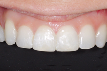 After - Dr Emma Facial Aesthetics