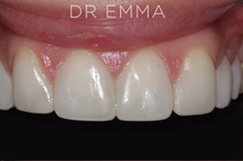 After - Dr Emma Facial Aesthetics
