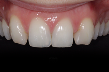 Before - Dr Emma Facial Aesthetics