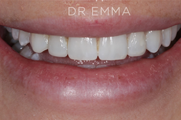 After - Dr Emma Facial Aesthetics