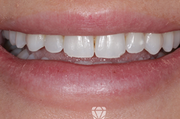 Before - Dr Emma Facial Aesthetics