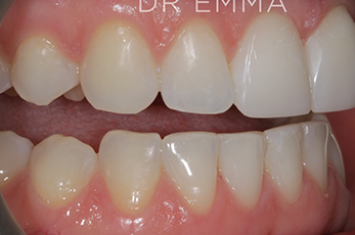 After - Dr Emma Facial Aesthetics