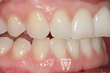 Before - Dr Emma Facial Aesthetics