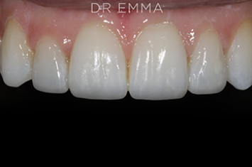 After - Dr Emma Facial Aesthetics
