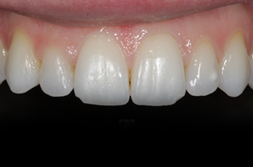 Before - Dr Emma Facial Aesthetics