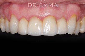 After - Dr Emma Facial Aesthetics
