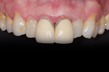 Before - Dr Emma Facial Aesthetics