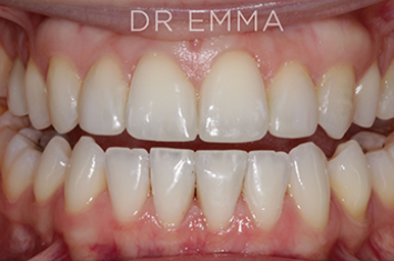 After - Dr Emma Facial Aesthetics