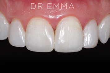 After - Dr Emma Facial Aesthetics