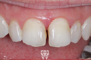 Before - Dr Emma Facial Aesthetics
