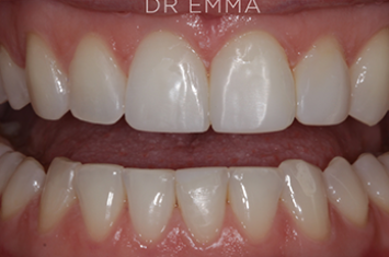 After - Dr Emma Facial Aesthetics