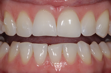 Before - Dr Emma Facial Aesthetics