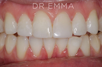 After - Dr Emma Facial Aesthetics
