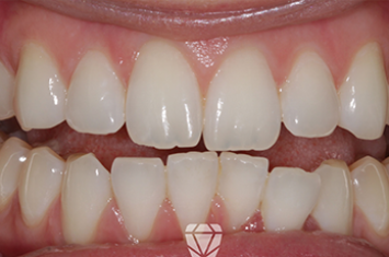 Before - Dr Emma Facial Aesthetics