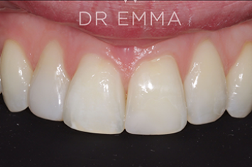 After - Dr Emma Facial Aesthetics