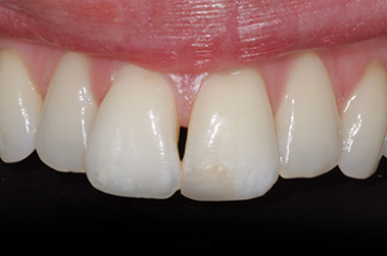 Before - Dr Emma Facial Aesthetics