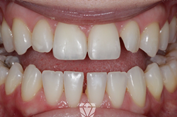 Before - Dr Emma Facial Aesthetics