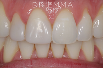 After - Dr Emma Facial Aesthetics