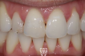 Before - Dr Emma Facial Aesthetics