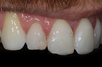 Before - Dr Emma Facial Aesthetics
