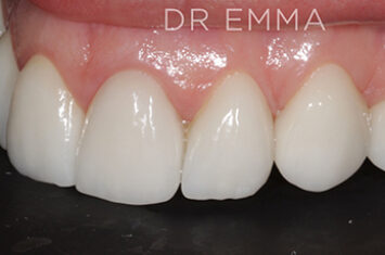After - Dr Emma Facial Aesthetics