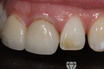 Before - Dr Emma Facial Aesthetics