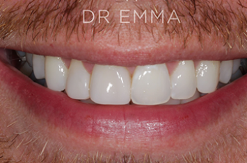 After - Dr Emma Facial Aesthetics