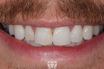 Before - Dr Emma Facial Aesthetics