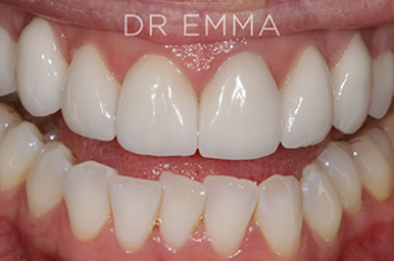 After - Dr Emma Facial Aesthetics