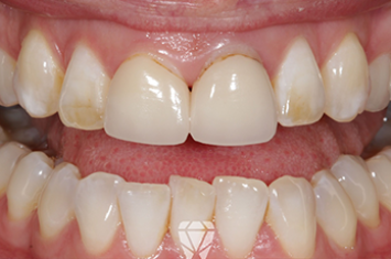 Before - Dr Emma Facial Aesthetics
