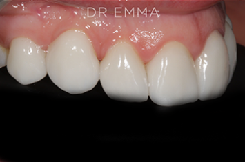 After - Dr Emma Facial Aesthetics