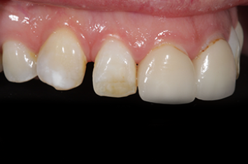Before - Dr Emma Facial Aesthetics