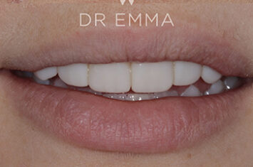 After - Dr Emma Facial Aesthetics