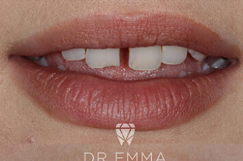 Before - Dr Emma Facial Aesthetics