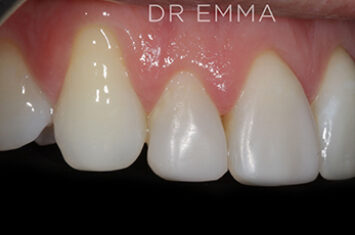 After - Dr Emma Facial Aesthetics