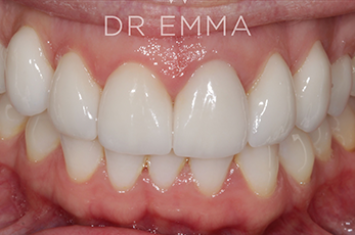 After - Dr Emma Facial Aesthetics