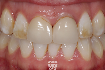Before - Dr Emma Facial Aesthetics