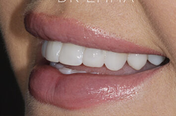 After - Dr Emma Facial Aesthetics