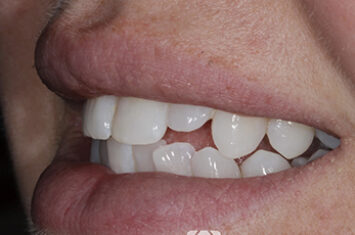 Before - Dr Emma Facial Aesthetics