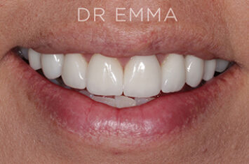 After - Dr Emma Facial Aesthetics