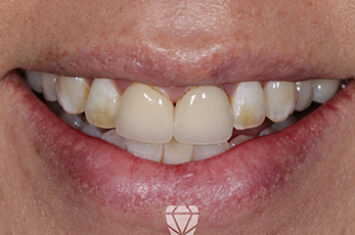 Before - Dr Emma Facial Aesthetics