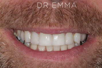 After - Dr Emma Facial Aesthetics