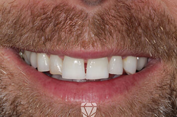 Before - Dr Emma Facial Aesthetics