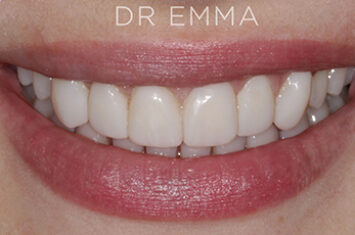 After - Dr Emma Facial Aesthetics