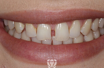 Before - Dr Emma Facial Aesthetics