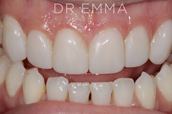 After - Dr Emma Facial Aesthetics