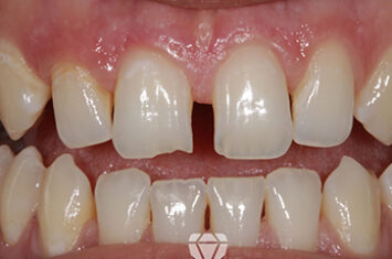 Before - Dr Emma Facial Aesthetics