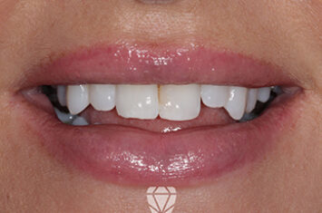 Before - Dr Emma Facial Aesthetics